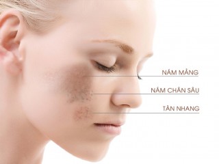 Tổng hợp các loại viên uống trị nám tàn nhang hiệu quả bạn nên biết